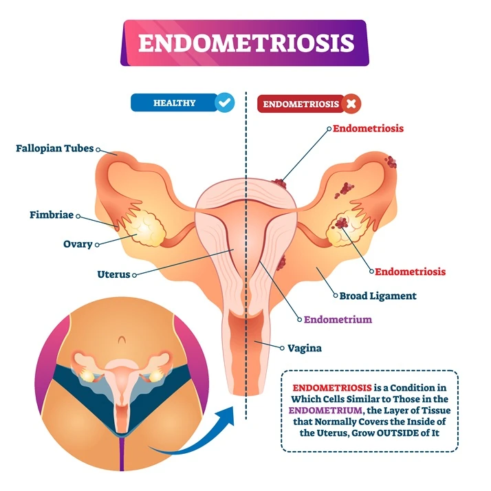 Endometriosis-info