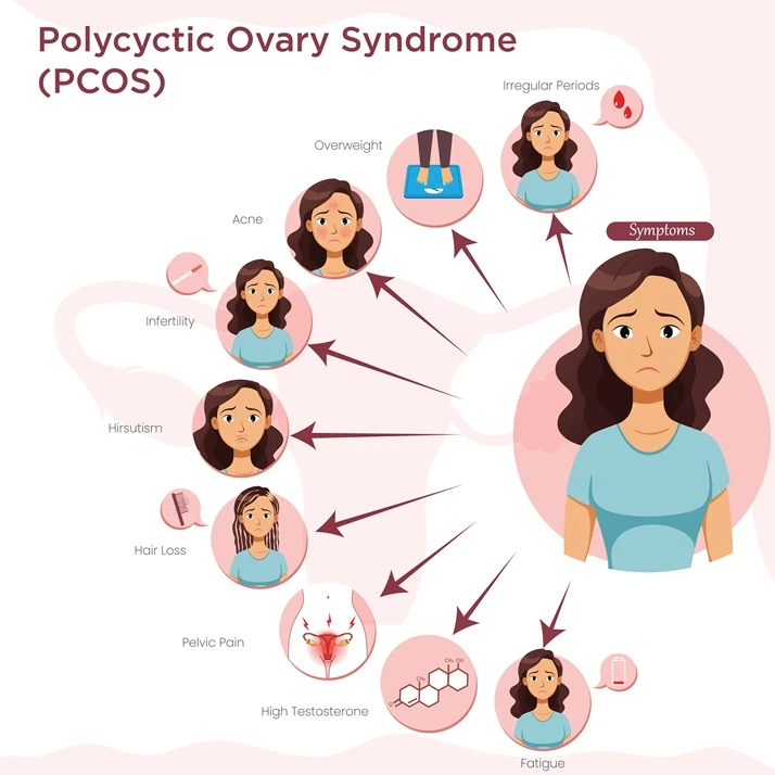 polycyctic-ovary-syndrome-pcos
